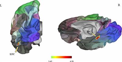 Brain Surface Area Alterations Correlate With Gait Impairments in Parkinson’s Disease